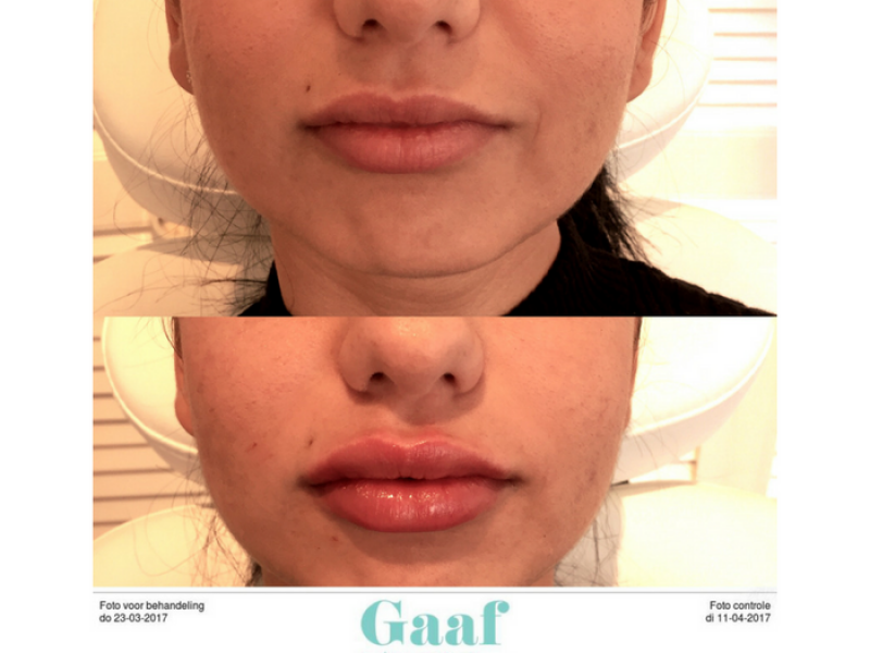 lippen opvullen den haag volle lippen dikke lippen botox lippen lipfillers lipvergroting hyaluronzuur fillers den haag