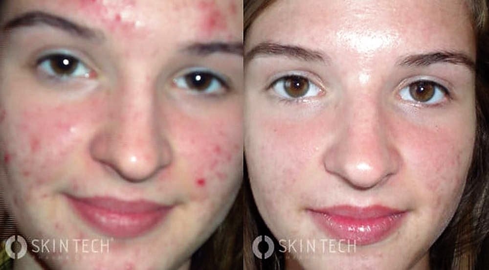 biologie Ashley Furman Armstrong Acne verminderen en acne littekens verwijderen - de nieuwste behandeling