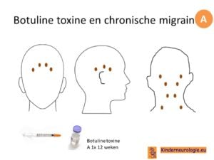 migraine hoofdpijn botox den haag