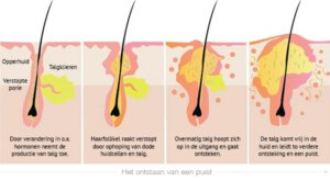 acne behandeling acne littekens verwijderen
